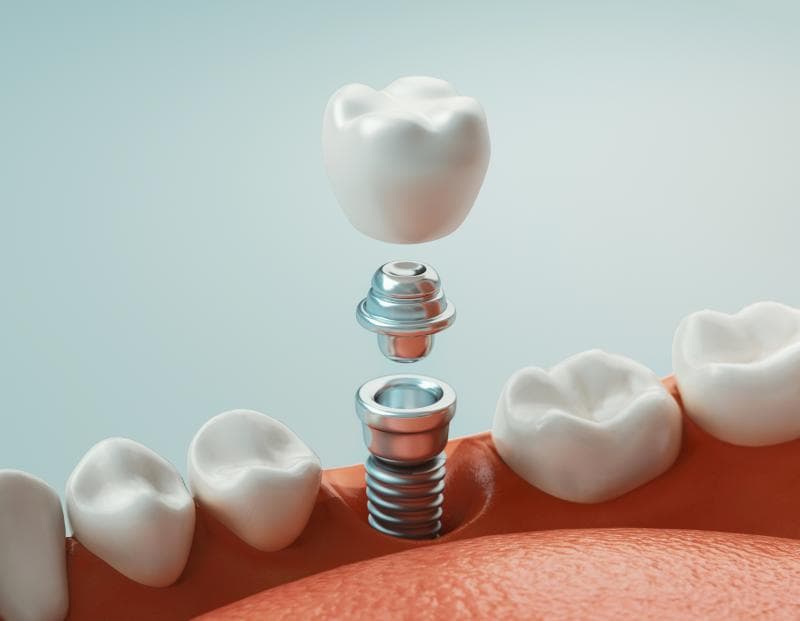 Dental implants require a surgical procedure since they are placed into the jawbone and act as artificial tooth roots that allow permanent or removable replacement teeth to be attached. The implant itself is extremely durable. It is ideal for those situations where the gum is not ready to support a denture.